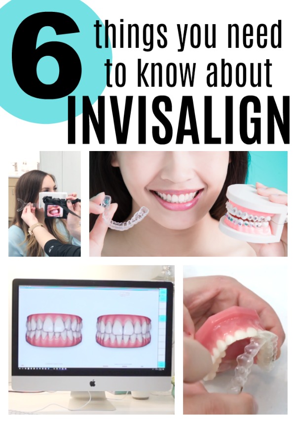 6 Things To Know About Invisalign with Defay Orthodontics