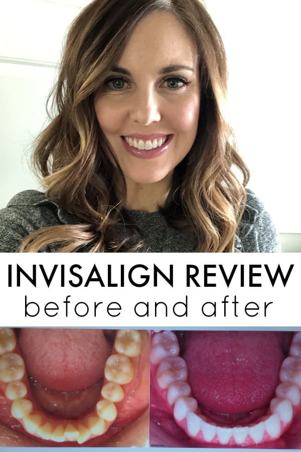 Before and After Invisalign Reveal [Review with Defay Orthodontics]